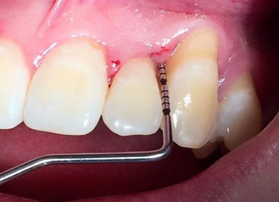 Bolsa periodontal 
