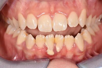 Gingivitis