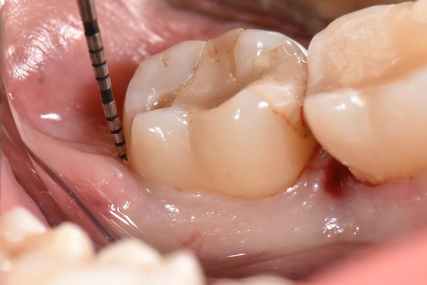 Periodontitis