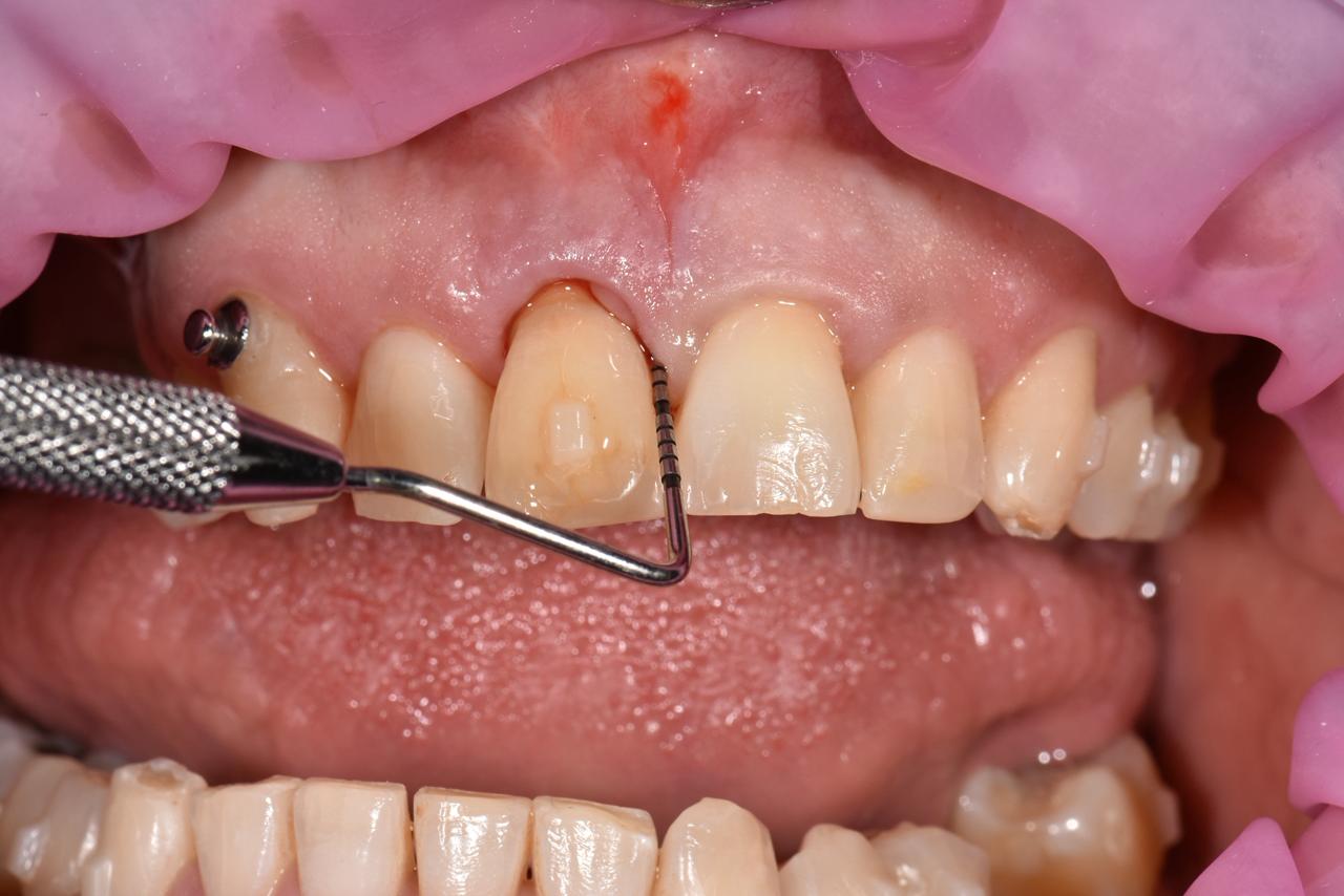 Bolsa Periodontal
