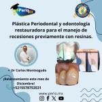 Plástica Periodontal y odontología restauradora para el manejo de recesiones previamente con resinas.$USD